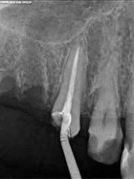 Endodoncias unirradiculares
